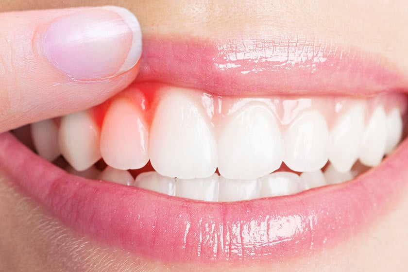 Periodontoloji; diş eti kanaması ve diş eti çekilmesi gibi diş eti hastalıkları tedavisi