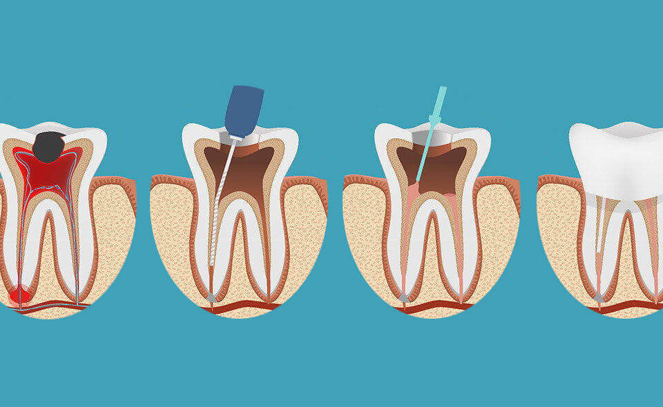 Kanal Tedavisi Endodonti