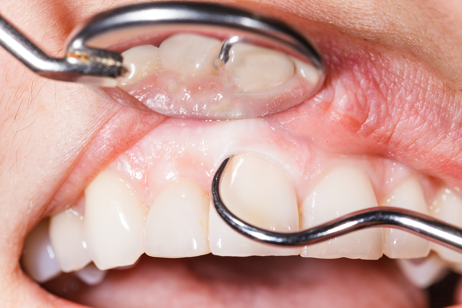 Periodontoloji (Diş Eti Hastalıkları) tedavisi